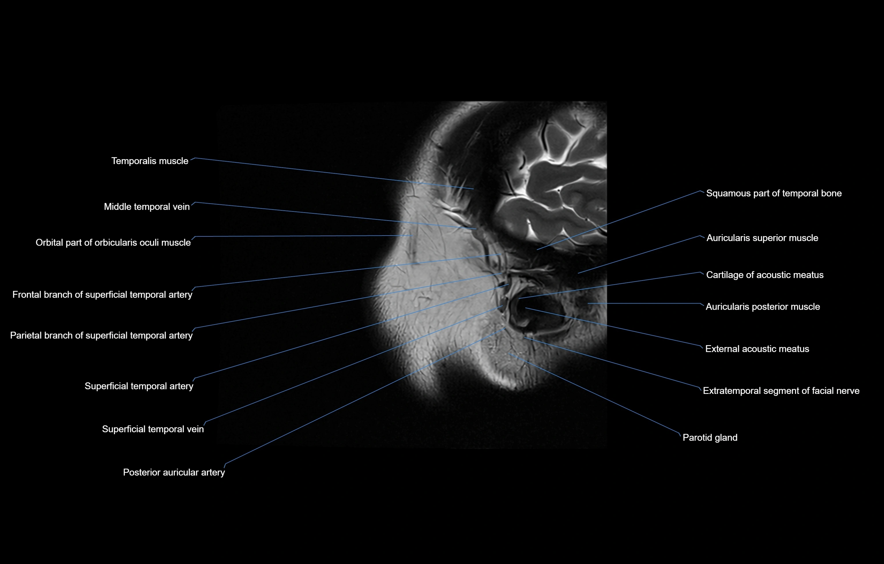 paranasal sinuses(PNS) MRI coronal  cross sectional anatomy 3T radiology  image-img-00001-00025.webp